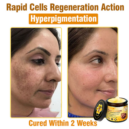 🔥FDA Approved: Ourlyard® Bee Venom Skin Restoration Cream — 🔥Limited Time 80% OFF🔥
