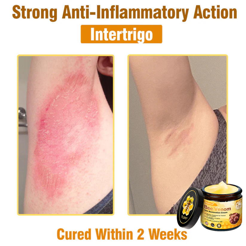🔥FDA Approved: Ourlyard® Bee Venom Skin Restoration Cream — 🔥Limited Time 80% OFF🔥
