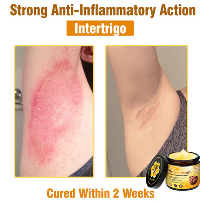 🔥FDA Approved: Ourlyard® Bee Venom Skin Restoration Cream — 🔥Limited Time 80% OFF🔥