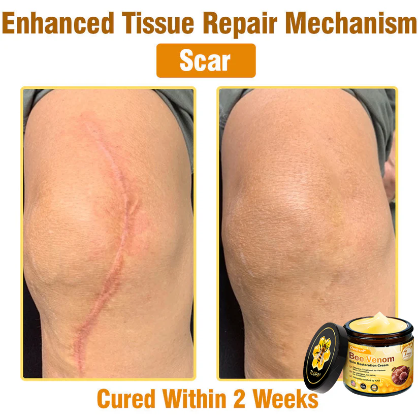 🔥FDA Approved: Ourlyard® Bee Venom Skin Restoration Cream — 🔥Limited Time 80% OFF🔥